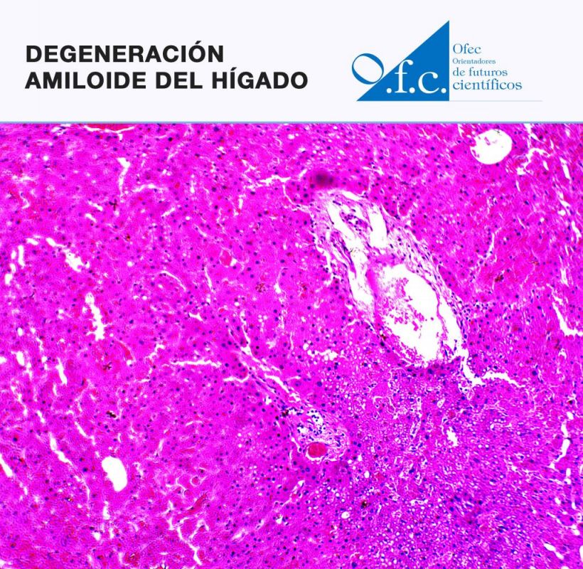 Degeneración amiloide del hígado