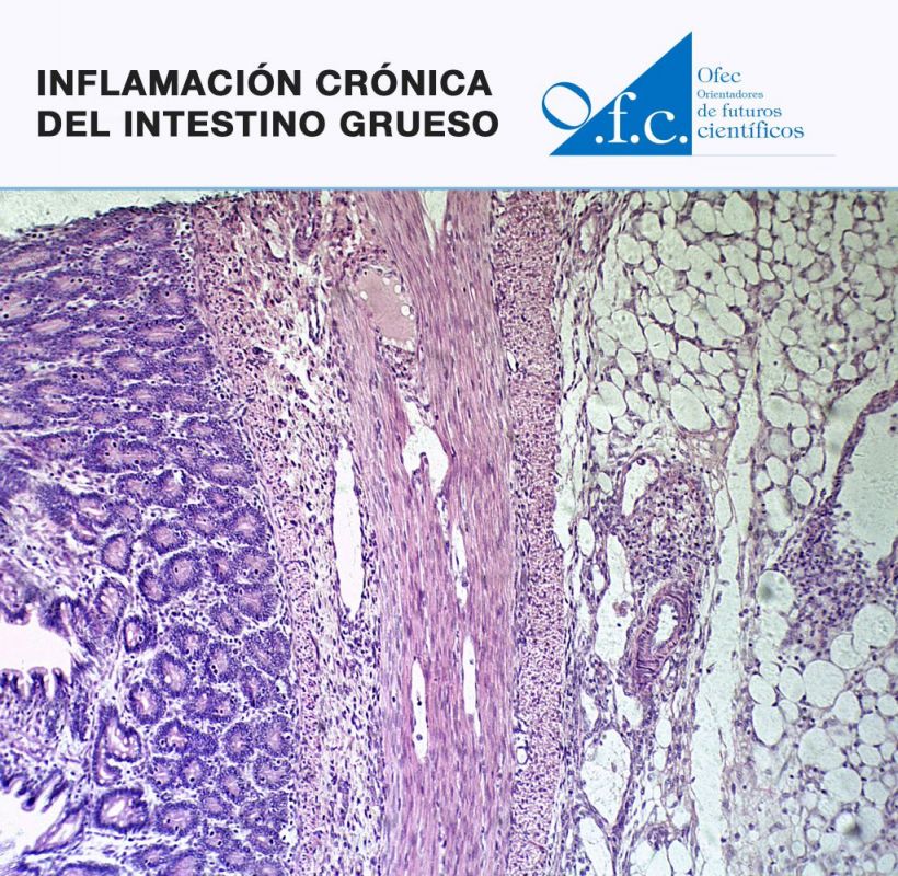 Inflamación crónica del intestino grueso