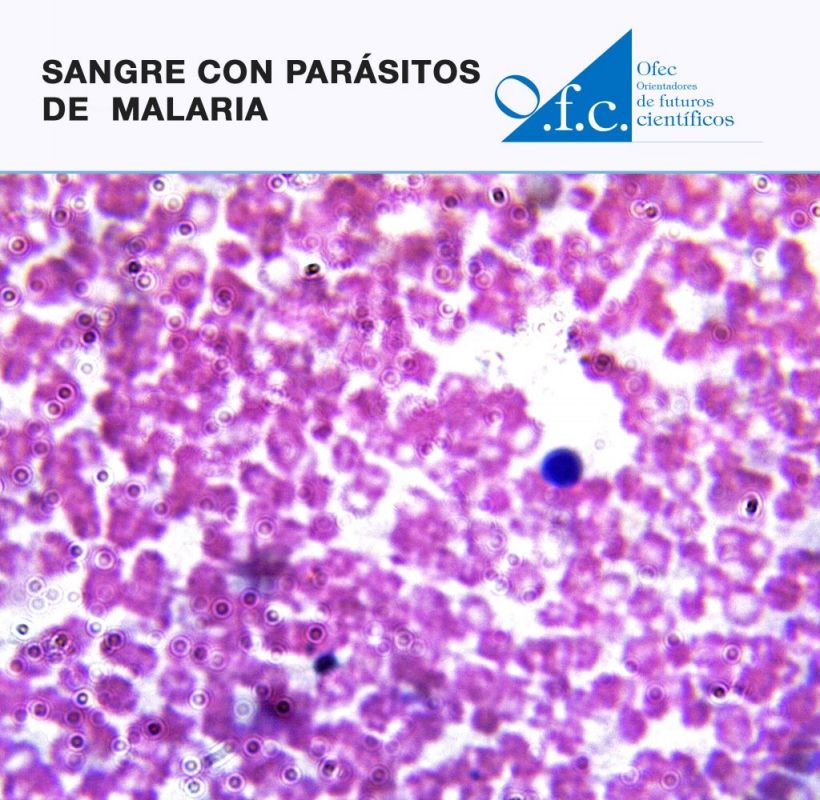 Sangre con parásitos de  malaria