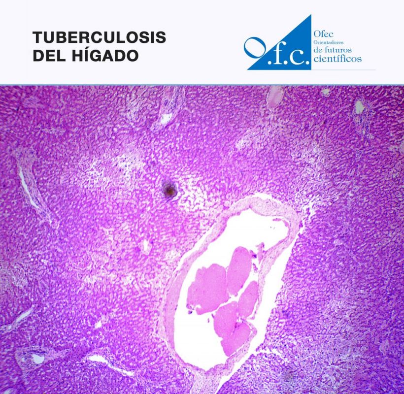 Tuberculosis del hígado